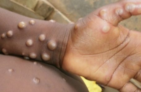 Africa CDC calls for enhanced surveillance, detection as monkeypox cases surpass 32,400