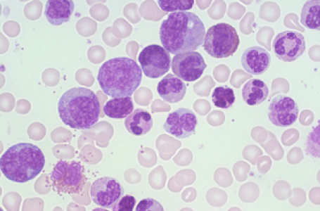 How targeted therapies are boosting outcomes for bone marrow cancer