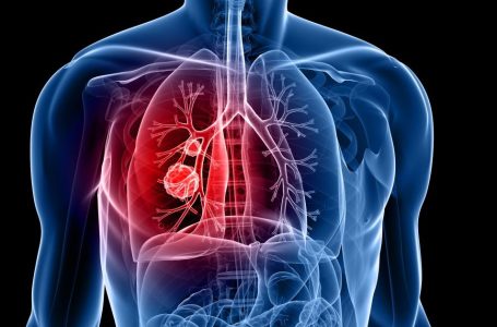 Doctors raise concern over rising lung cancers among non-smokers in India