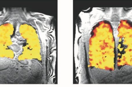 Scientists develop scan that unravels secrets of lung function